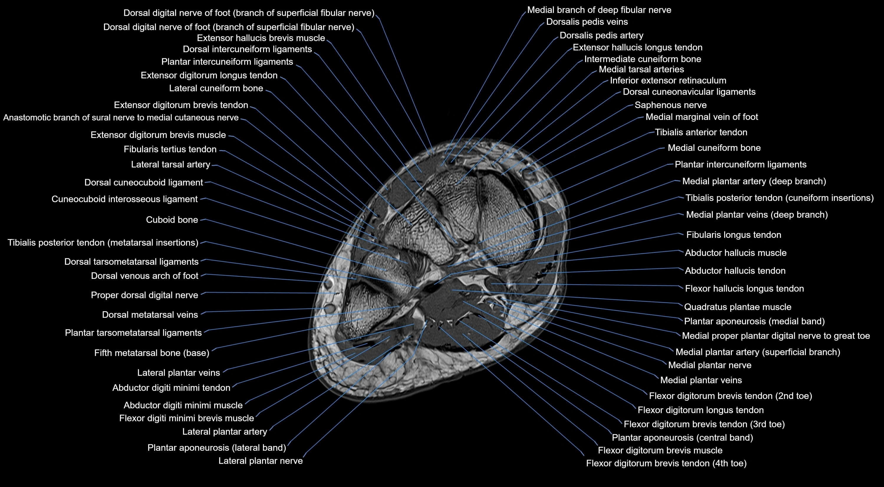 MRI mid foot coronal ligaments cross sectional anatomy 3T  radiology  image-img-00001-00022.webp